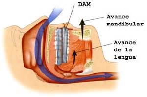 RoncoApnea - ➡️ DAM: Dispositivo de Avance Mandibular . ✓